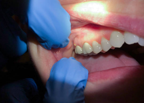 Best Emergency Broken Tooth Repair in Lumbine, CO